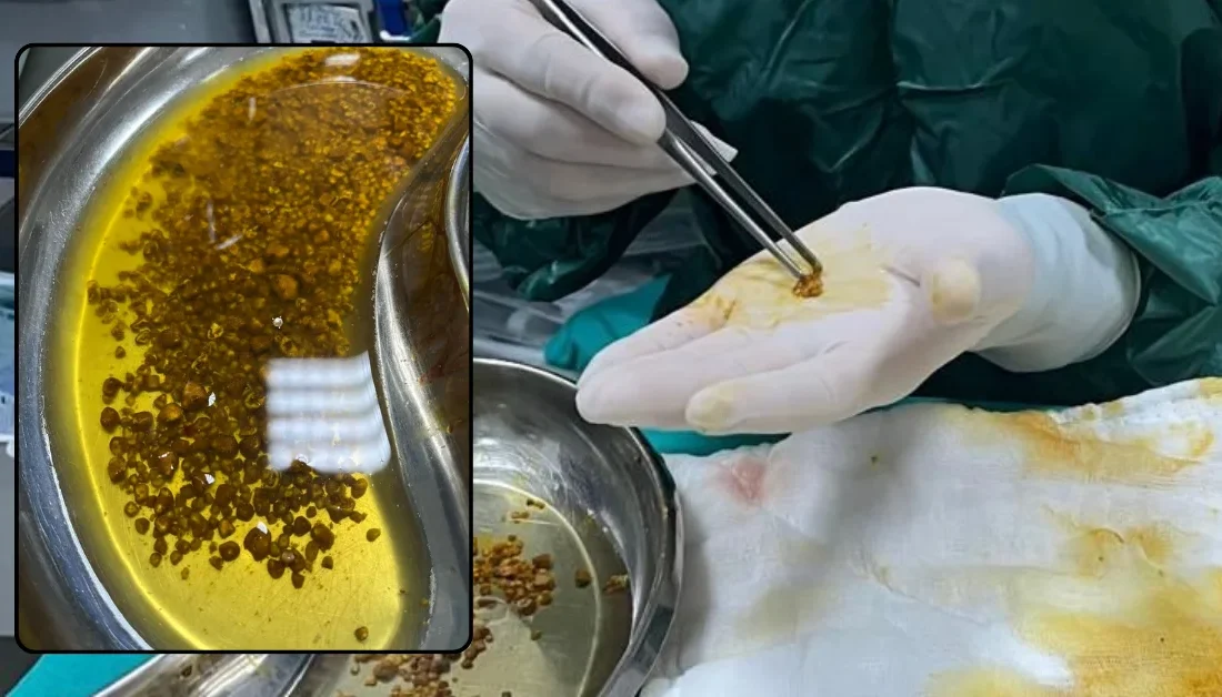 Bingöl Devlet Hastanesi’nde gerçekleştirilen kapalı safra kesesi ameliyatında, bir hastadan