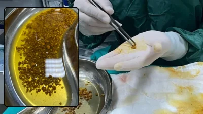 Bingöl Devlet Hastanesi’nde gerçekleştirilen kapalı safra kesesi ameliyatında, bir hastadan